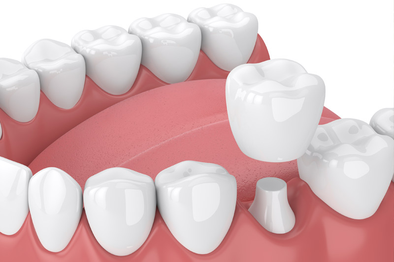 Dental Crowns in Chattanooga