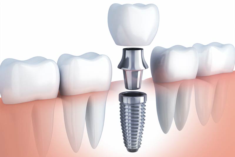 Implants Dentist in Chattanooga