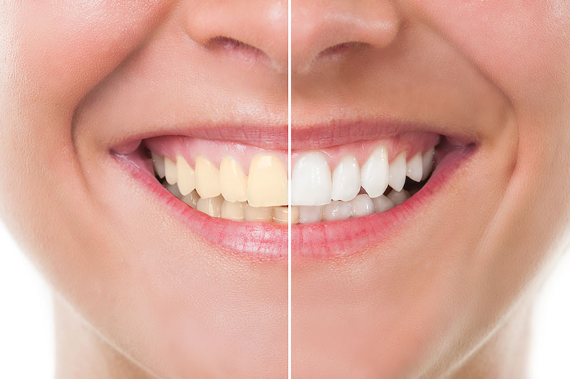 Teeth Whitening in Chattanooga